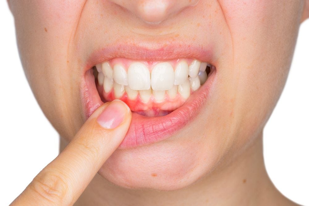 Deep Gum Pockets — Things You Need To Know by Efrain Muncy Medium