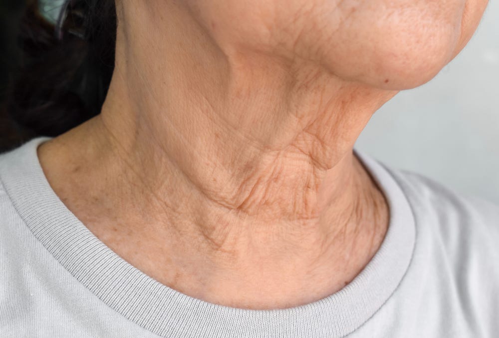 Aging neck Why you have it and how to get rid of? by London Beauty