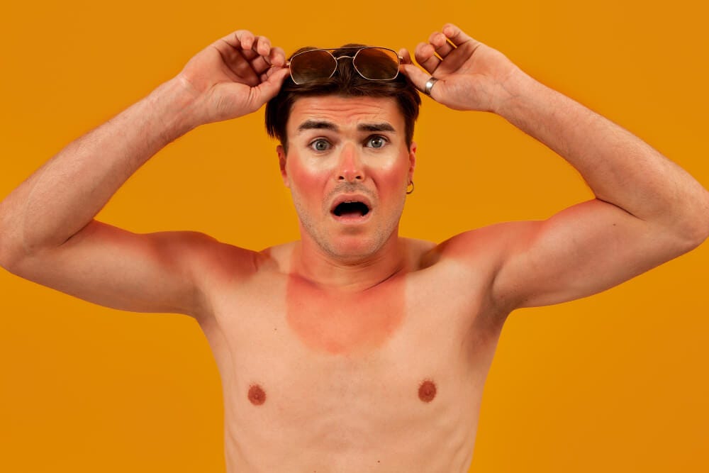 Different Types of Sunburn and How to Avoid Them Jason Stone Medium