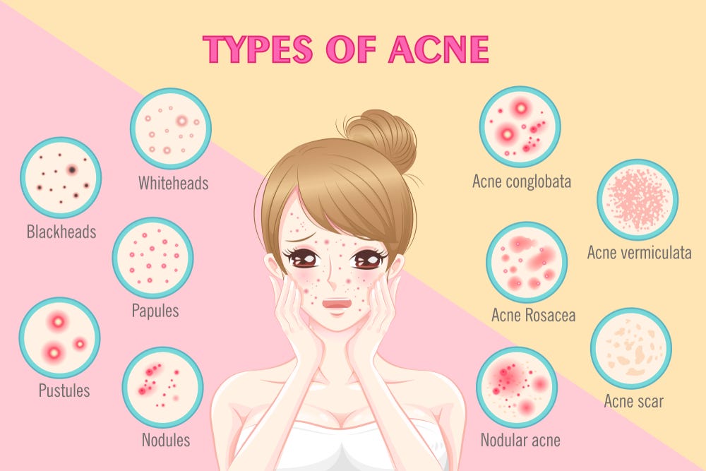 Understanding Acne A Complete Guide to Different Types of Acne