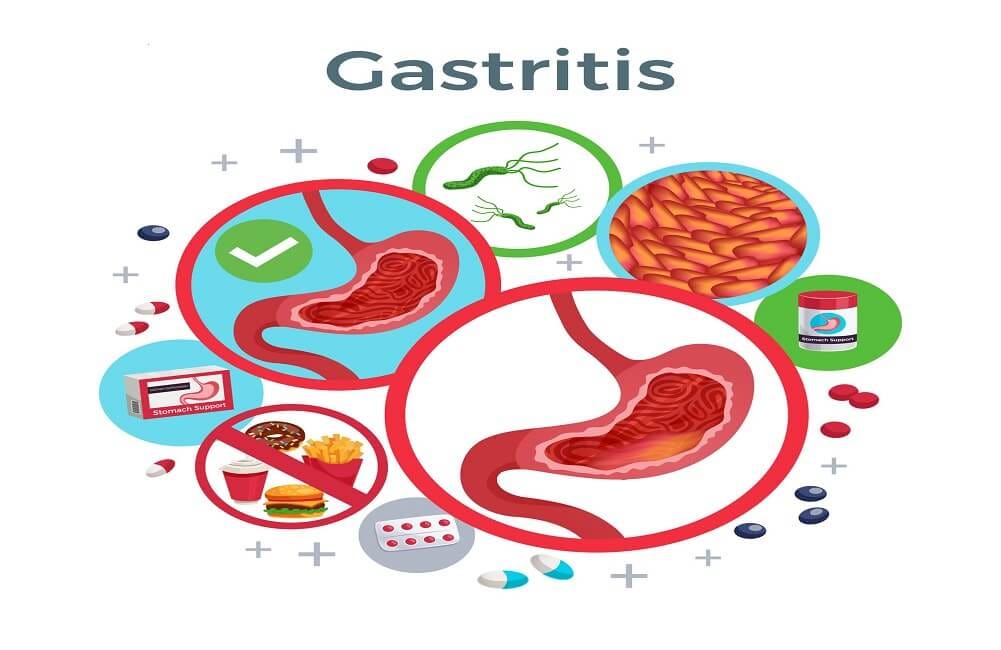 How are Homeopathy medicines beneficial for treating Gastritis