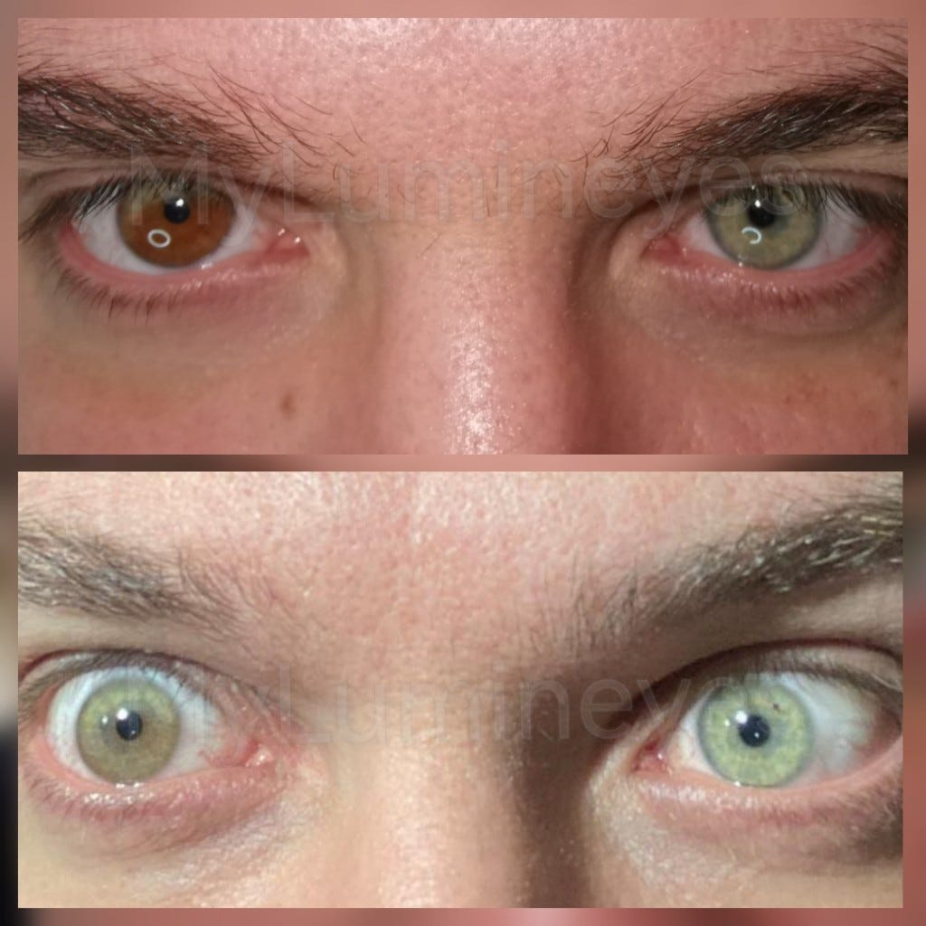 Surgery to change eye color. How to Naturally Change Your Eye Color