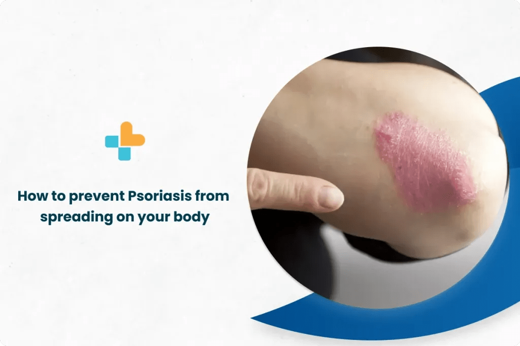 How to Prevent Psoriasis From Spreading On Your Body by Ayu Health