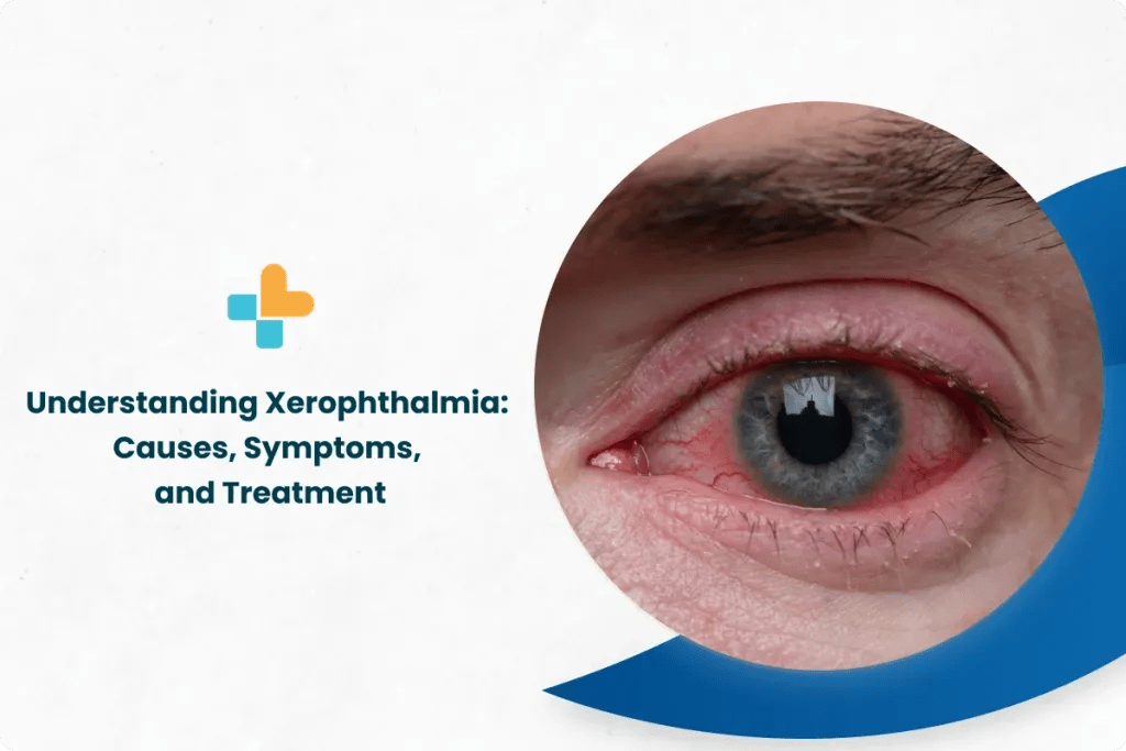 Understanding Xerophthalmia Causes, Symptoms, and Treatment by Ayu