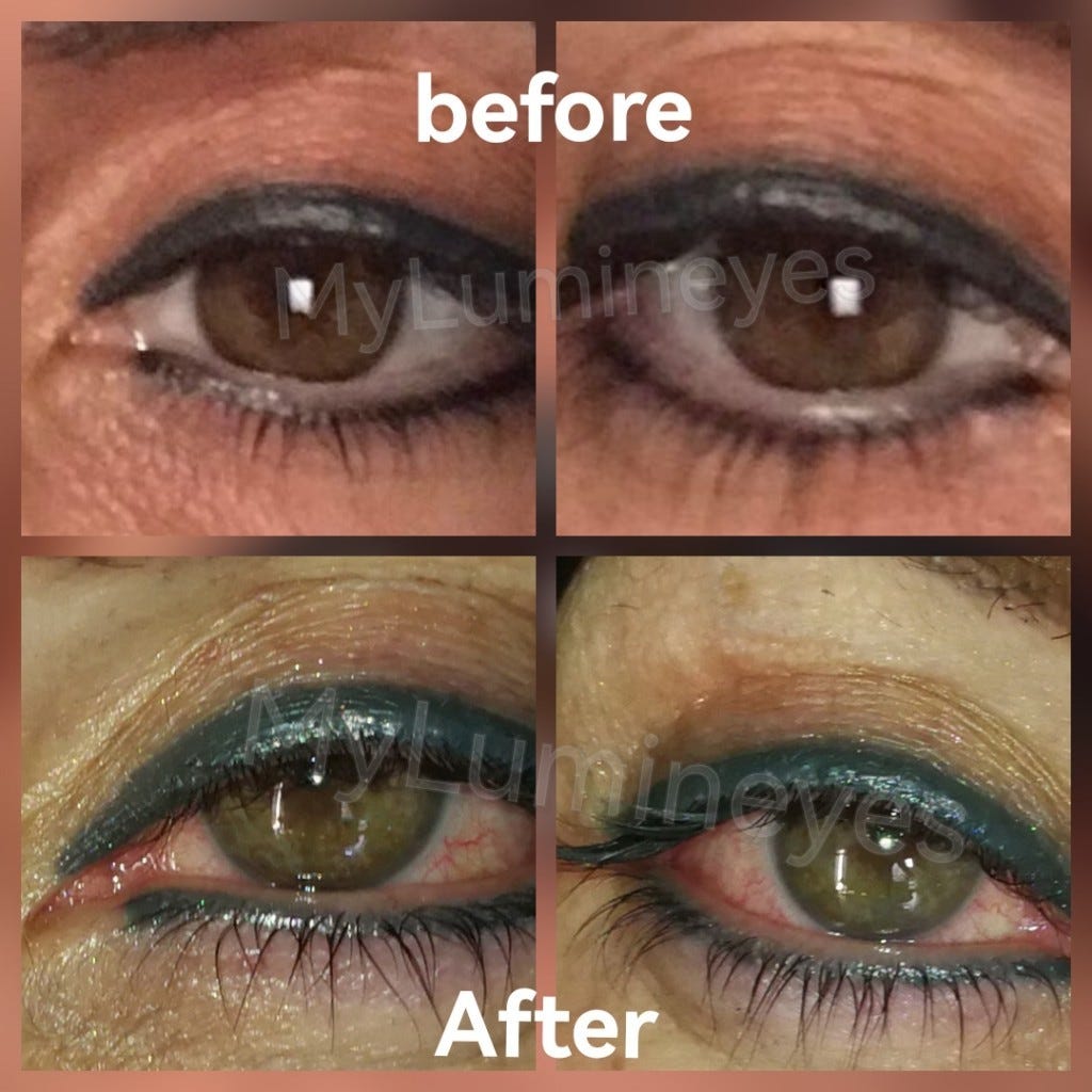 Lumineyes eye color change surgery — Turkey Eye Color Change Surgery