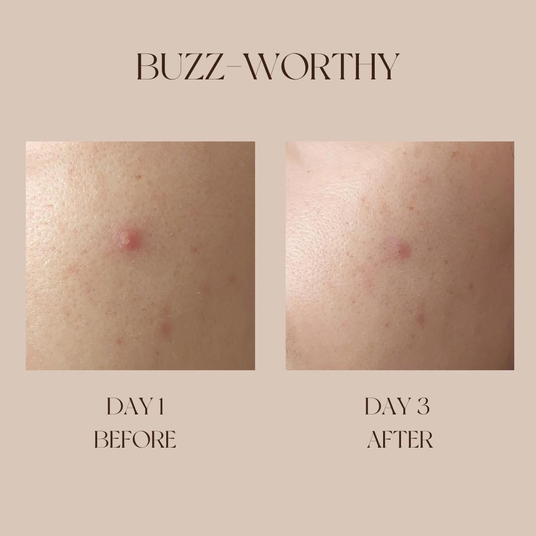 Manuka Honey for Pimples PollenNation Skin Medium