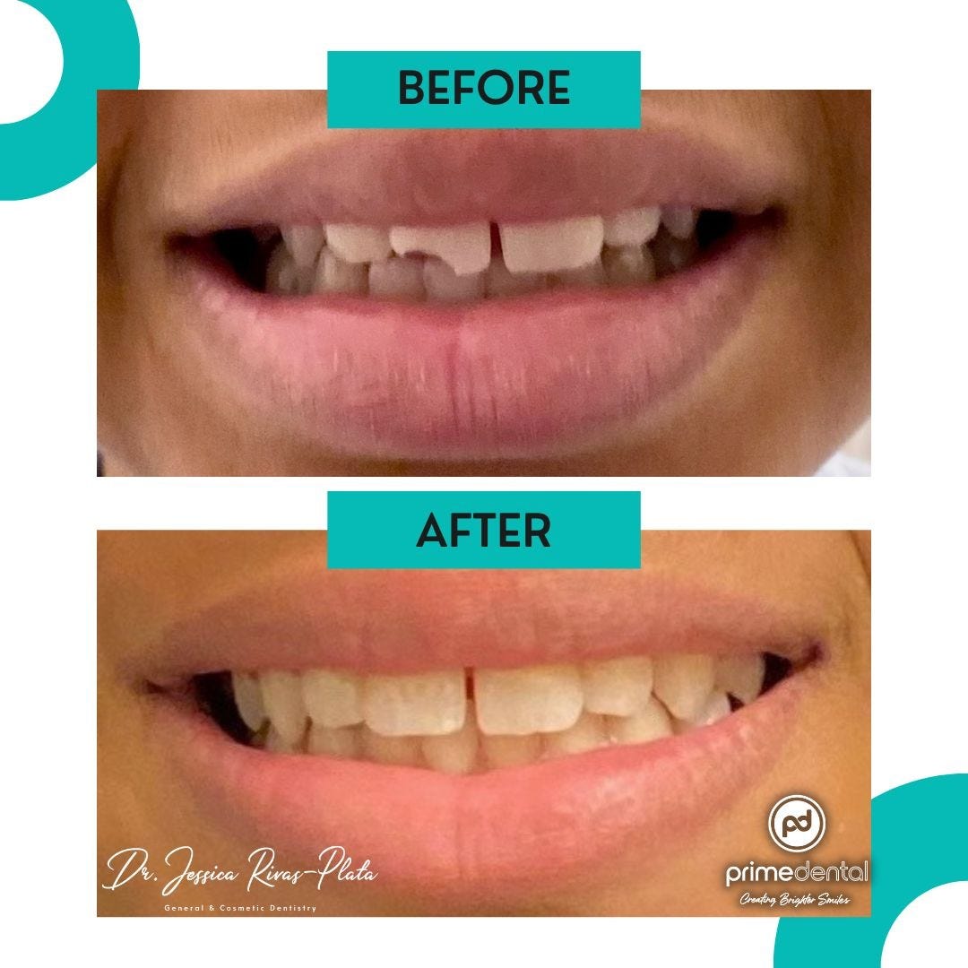 Veneer & Your Lifestyle How to Maintain Your Perfect Smile in Real
