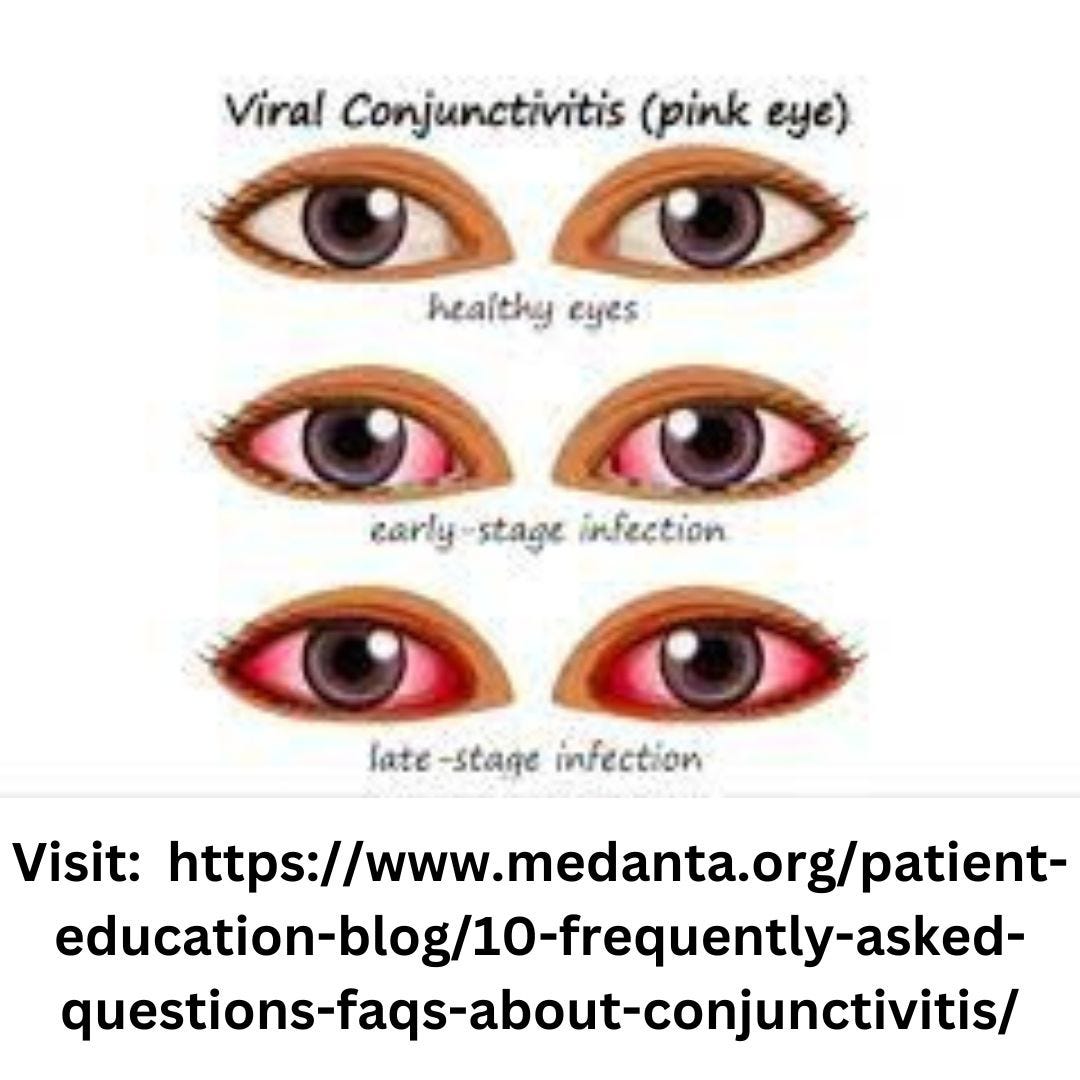Understanding Eye Conjunctivitis Causes, Symptoms, and Treatment by