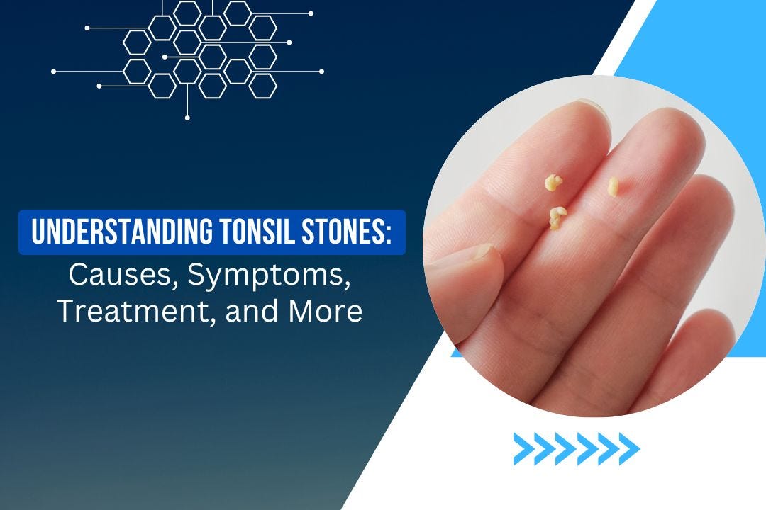 Understanding Tonsil Stones Causes, Symptoms, Treatment, And More by