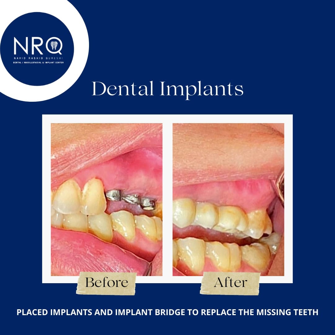 Dental Implants to replace missing teeth Drprofnavidqureshi Medium