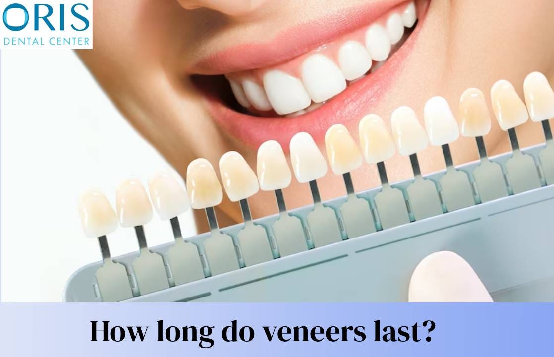 How long do veneers last?. Dental Veneers in Dubai — Oris Dental… by