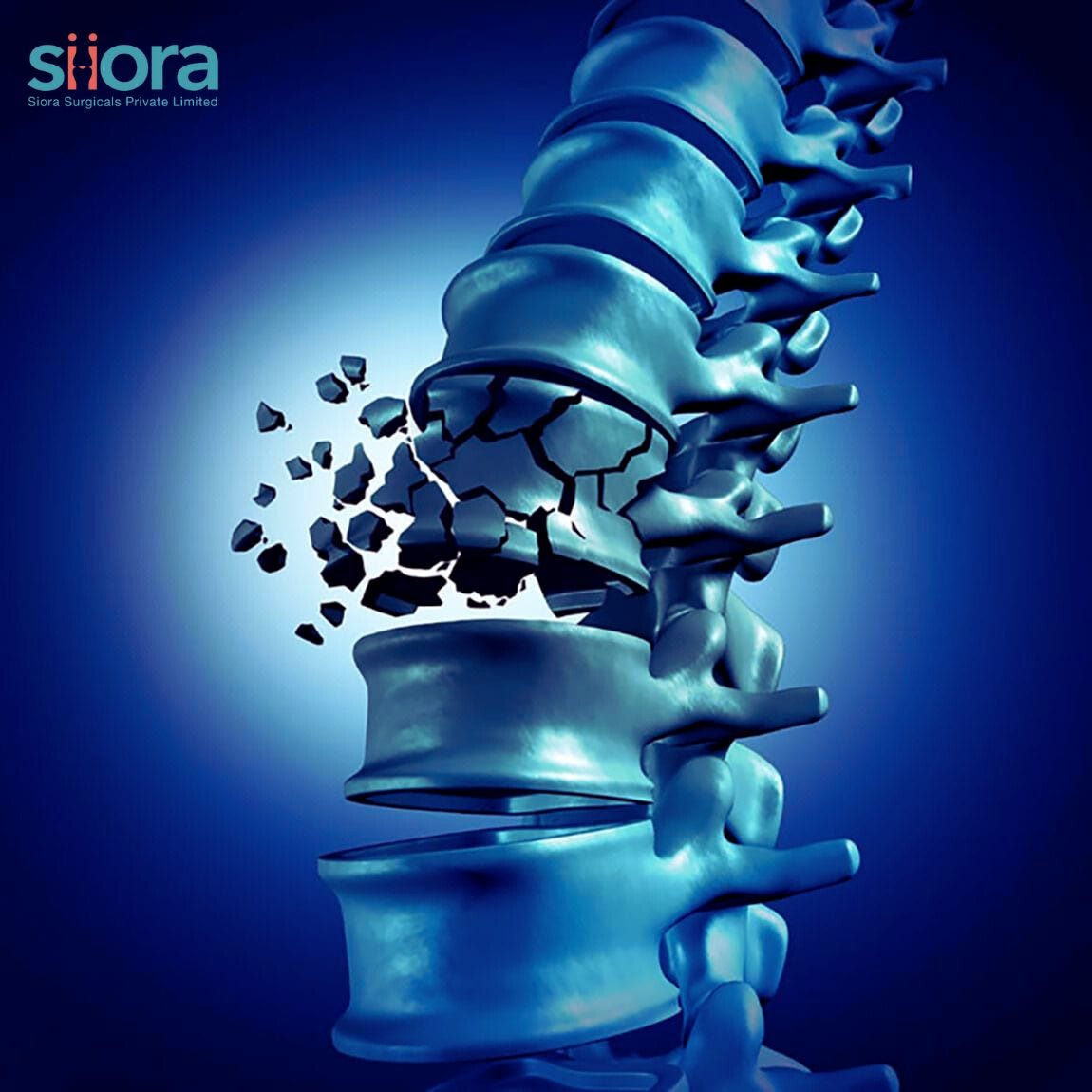 An Expert Guide on the Types of Spinal Fractures Siiora Surgical Medium