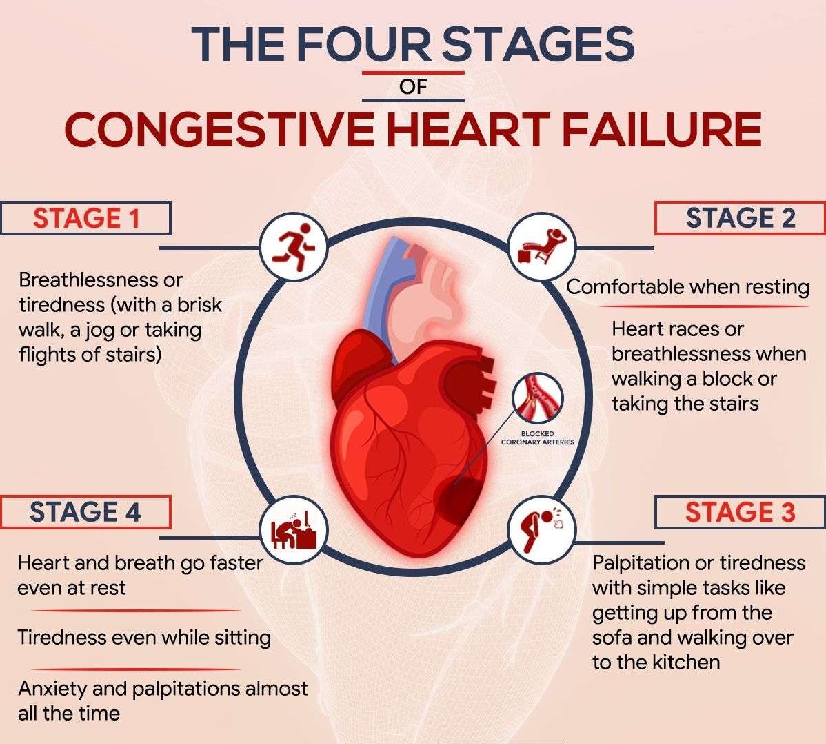 Demystifying Congestive Heart Failure A Comprehensive Overview by