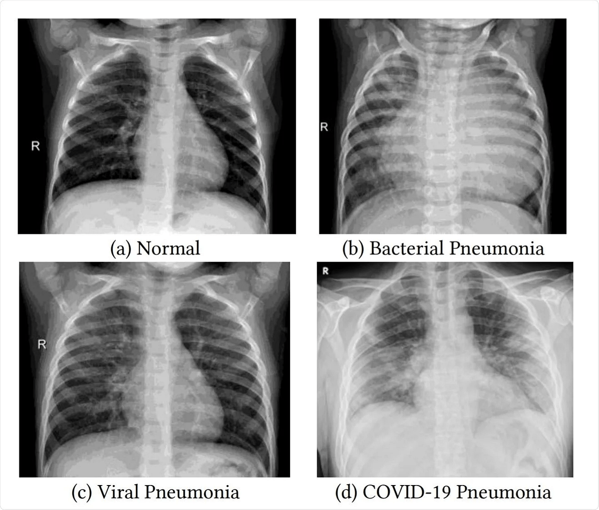 Detecting Pneumonia in Chest XRays Using Various Deep Neural Nets by