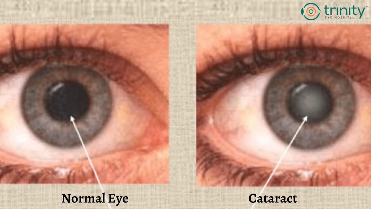 Cataract Surgery. An eye procedure called cataract… by