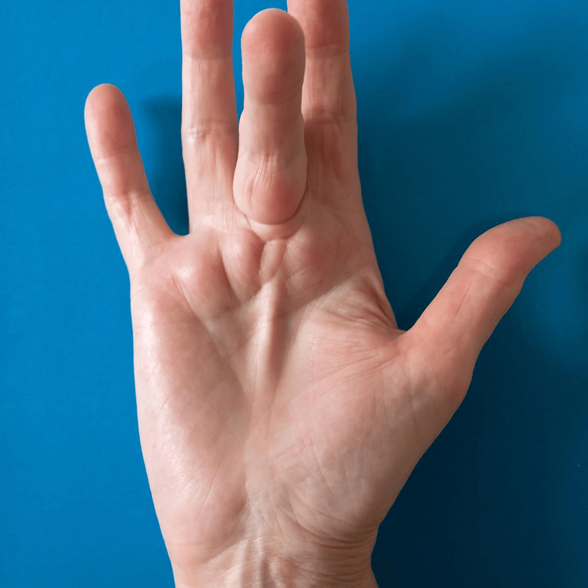 Occupational-Based Hand Therapy. Hand therapy is an occupational