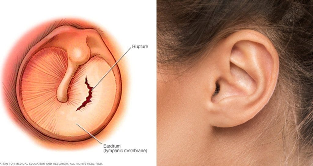 How Does Eardrum Perforation Happen? How does it go? by Horoscope