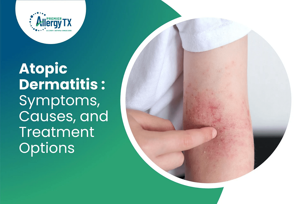 Understanding Atopic Dermatitis Symptoms and Treatments by