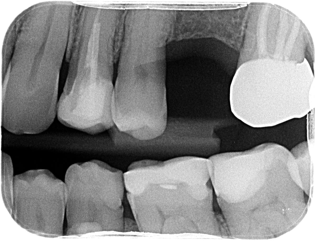 24 layered Emax crown and 27 monolithic Zirconia crown (31/10/2022