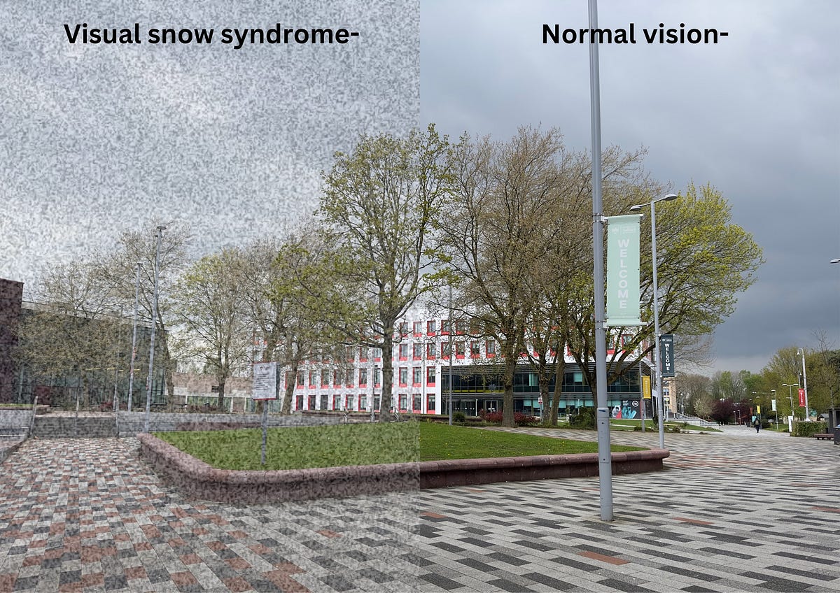 Through the eyes of ‘visual snow syndrome.’ A condition that affects 2