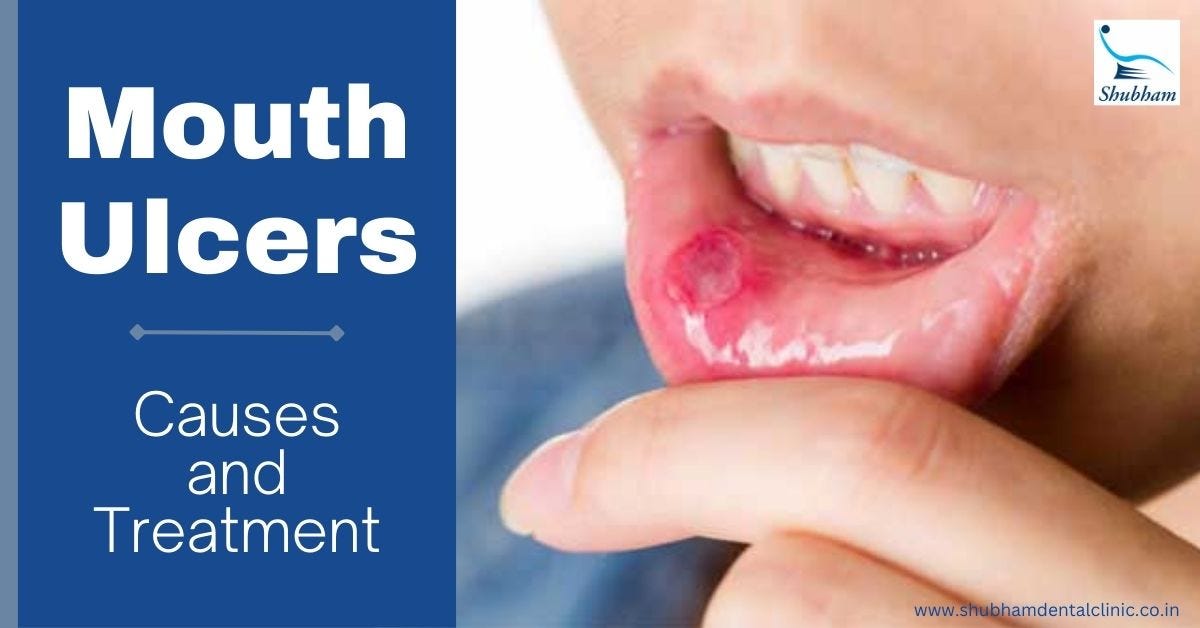 Mouth ulcers causes and treatment by Dr. Rinku Mittal's Shubham dental clinic Medium
