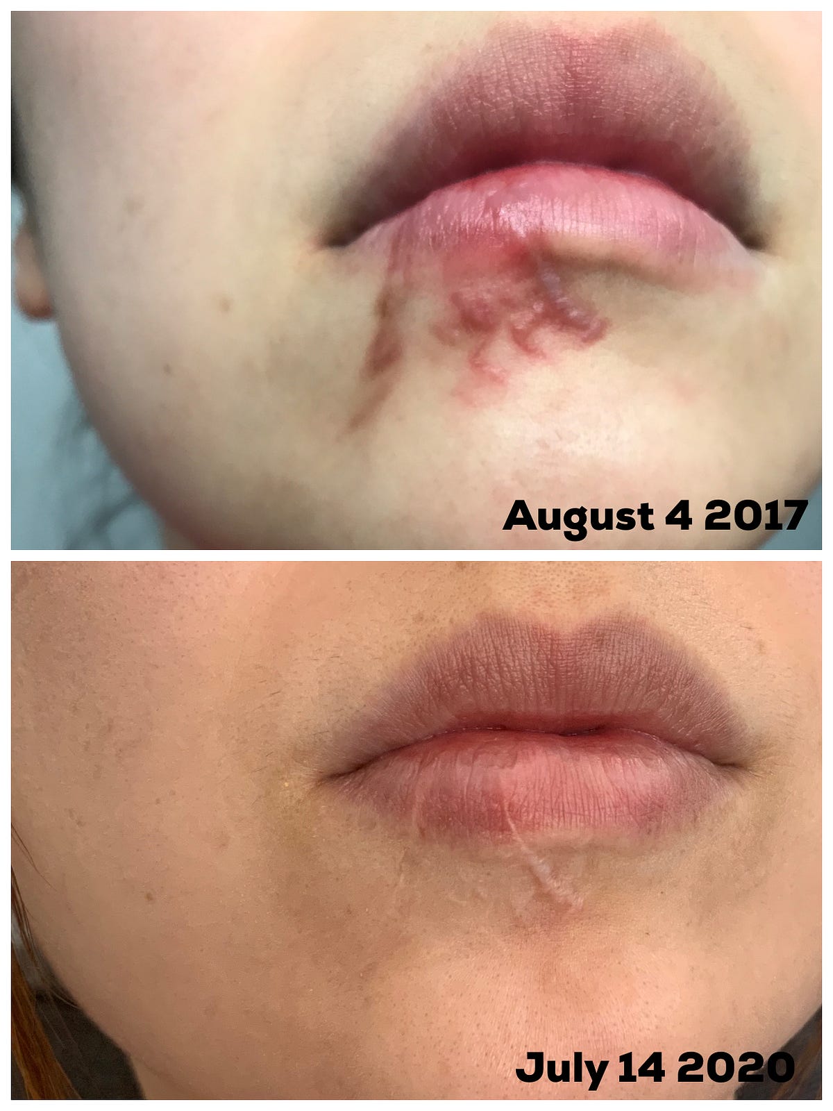 A Visual Timeline of Healing from a Dog Bite by Cindy Chu Medium