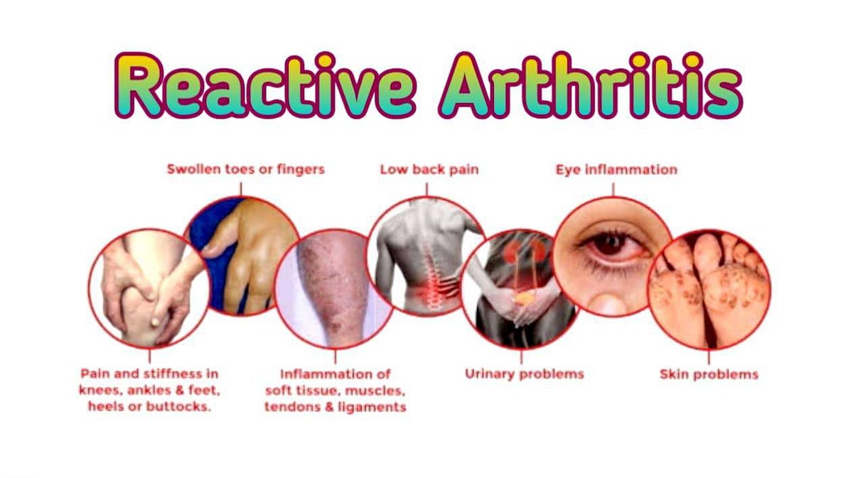 Reactive Arthritis. A review on Reactive Arthritis by Muhammad Hammad
