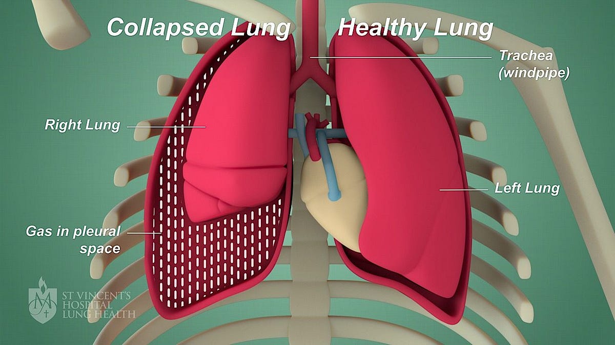 Detection and Semantic Segmentation of Pneumothorax Disease from XRay