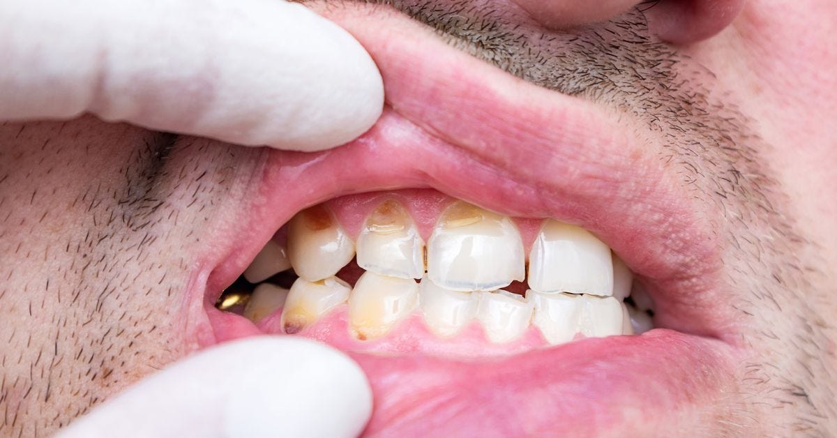 The Practice of Shaving Teeth for Veneers A Detailed Exploration by Hill Dentistry