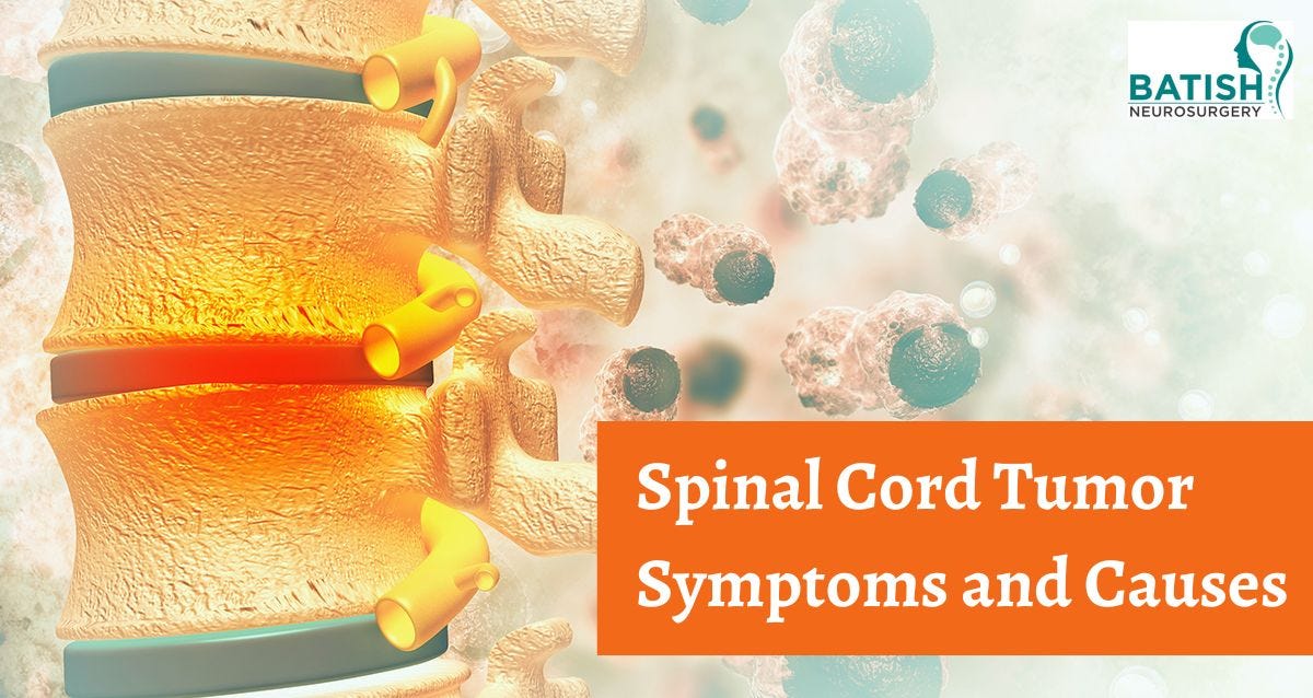 Spinal Cord Tumor Symptoms and Causes by Rohan Bhatt Medium