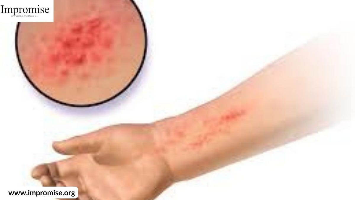 How long do hives last Medium