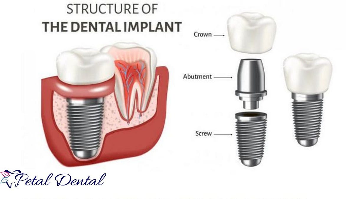 Implant Crowns and Root Canals A Comprehensive Guide to Dental Health