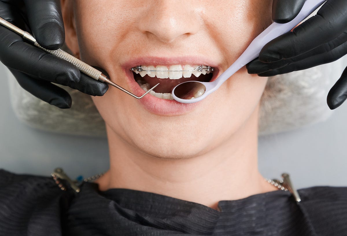 How Orthodontists Can Correct Crossbites Orthodontics Newcastle by