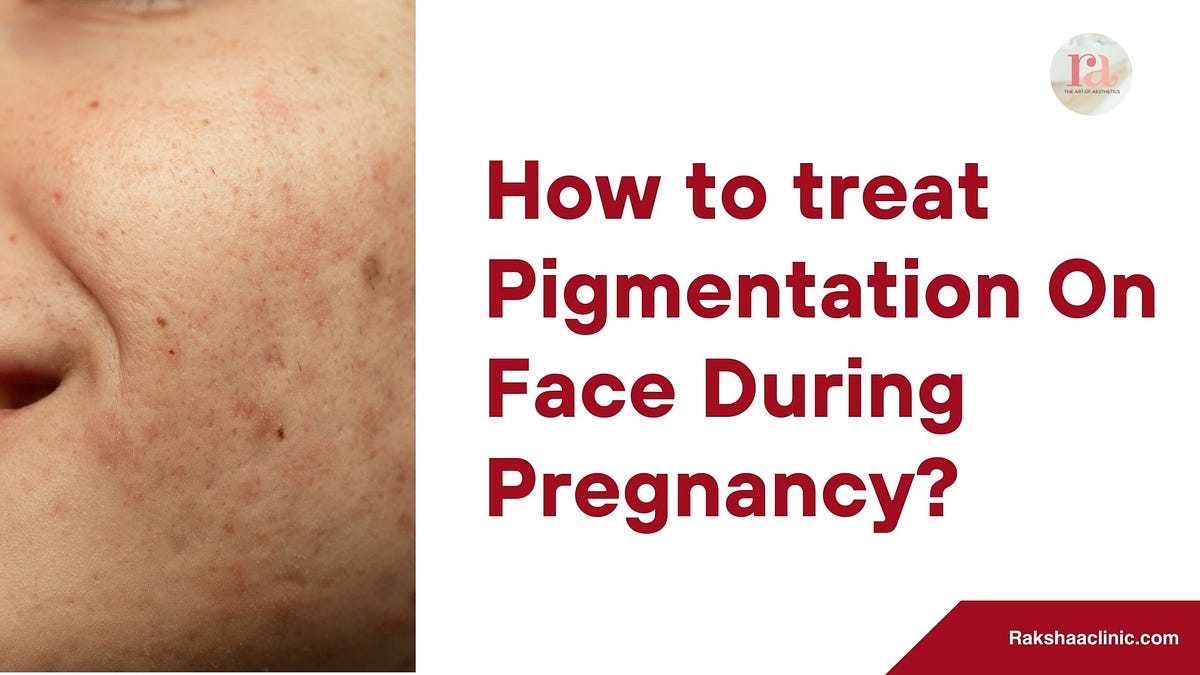 How to treat Pigmentation On Face During Pregnancy? Rakshaa_clinic