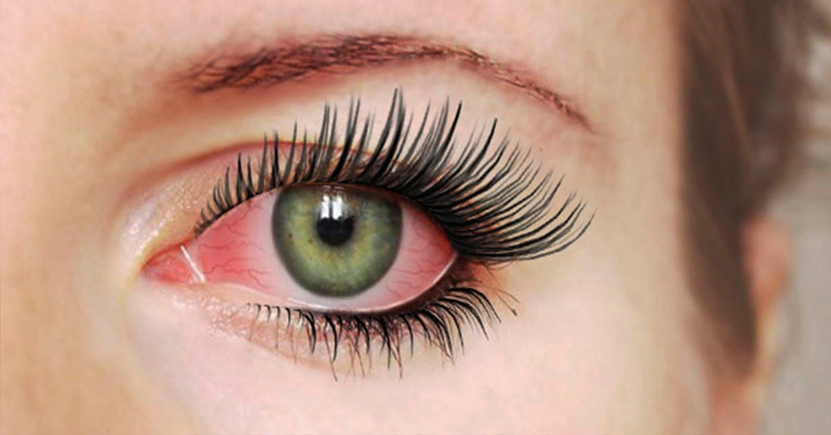 How to Treat Red Eyes After Eyelash Extensions by Sam Smith Jul
