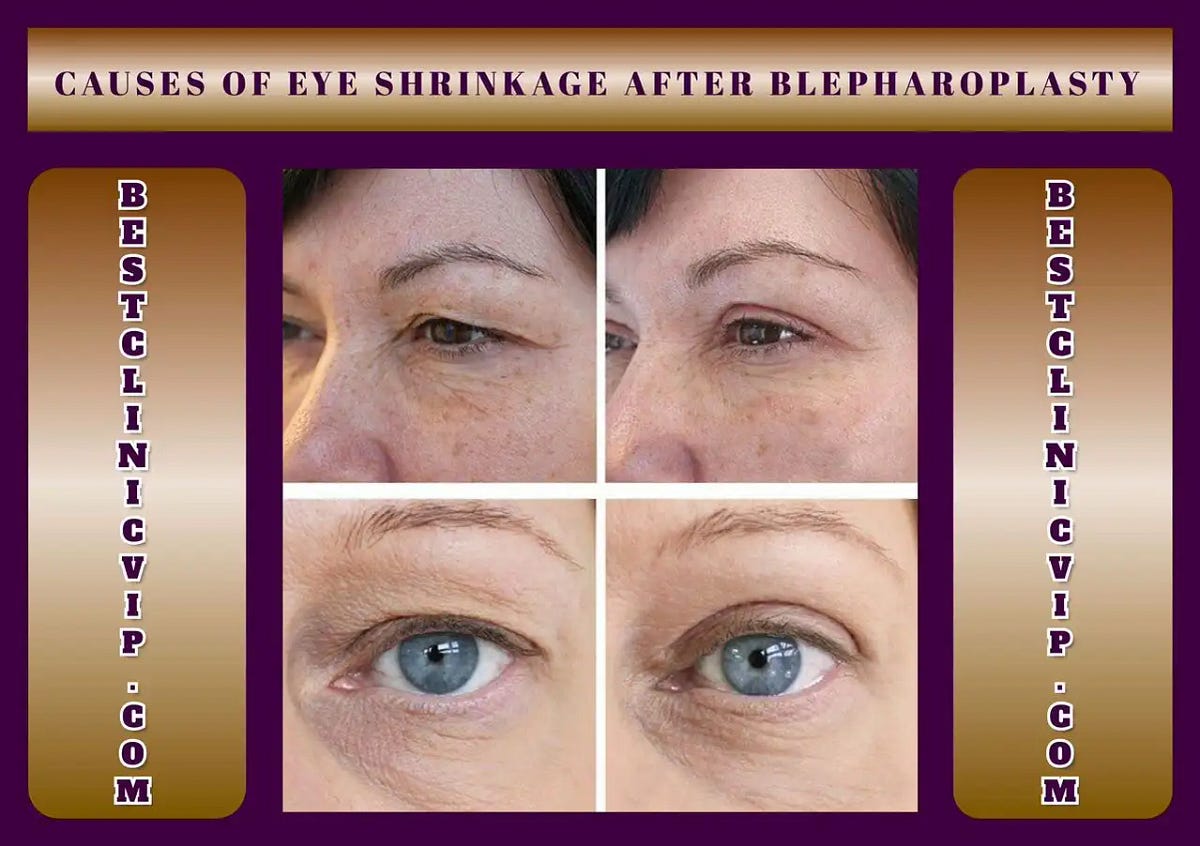 Causes of eye shrinkage after blepharoplasty by best clinic May