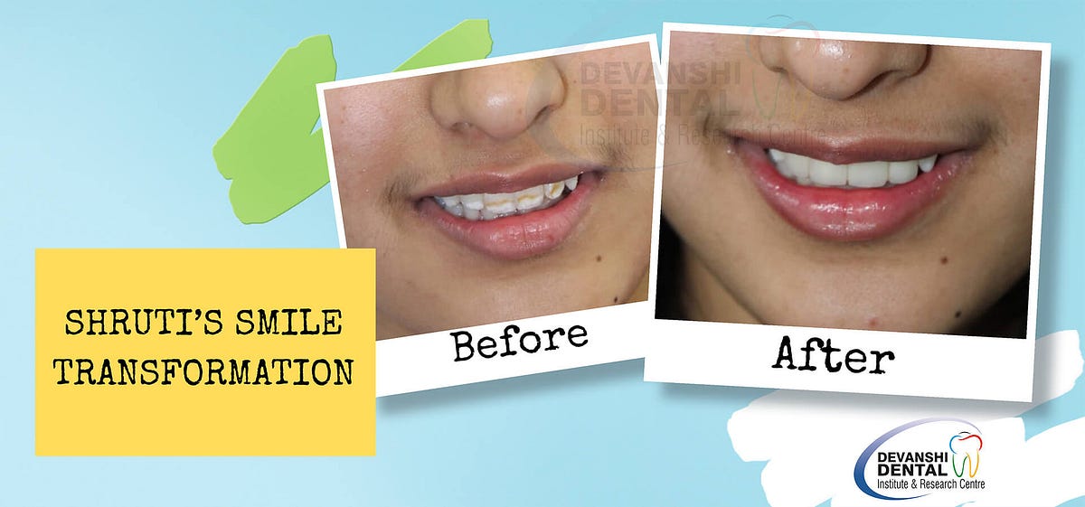 How Long Do Veneers Last on Your Teeth? Unveiling the Secrets to a Dazzling Smile by Devanshi