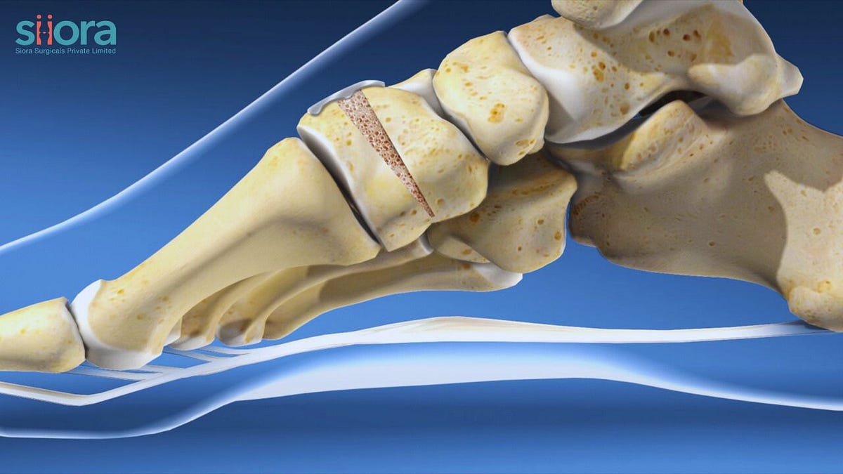 What is Osteotomy? What Should You Know? Siiora Surgical Medium