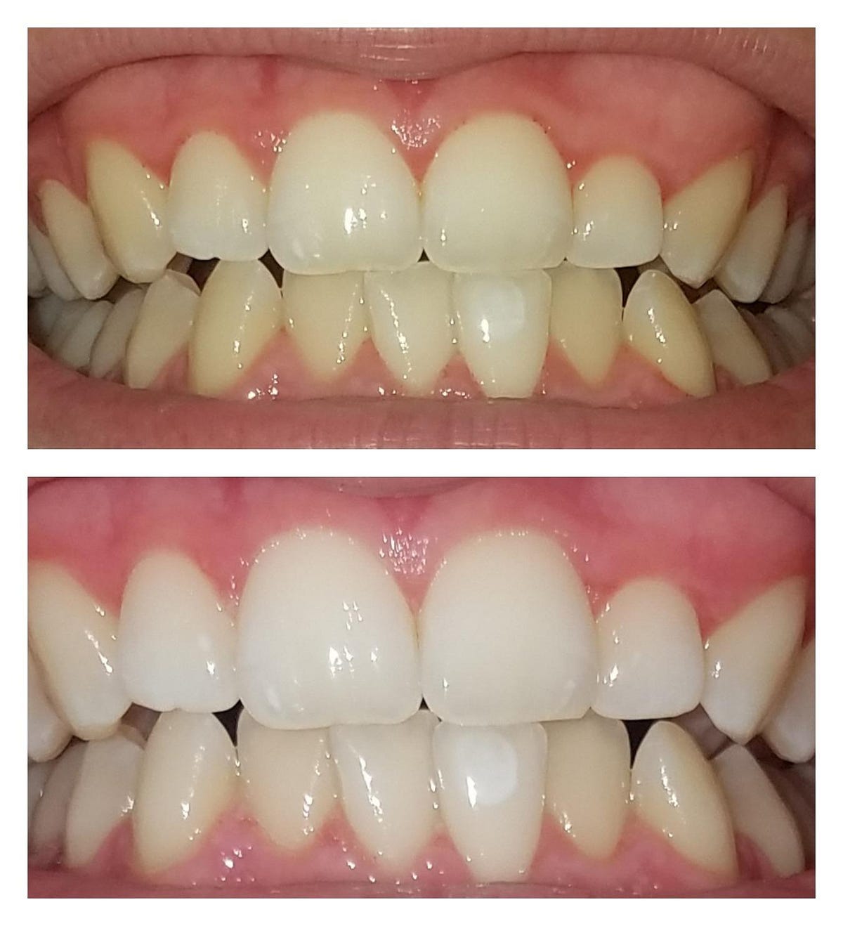 Do Crest Whitestrips Supreme work? [Before & After Images] by Dr