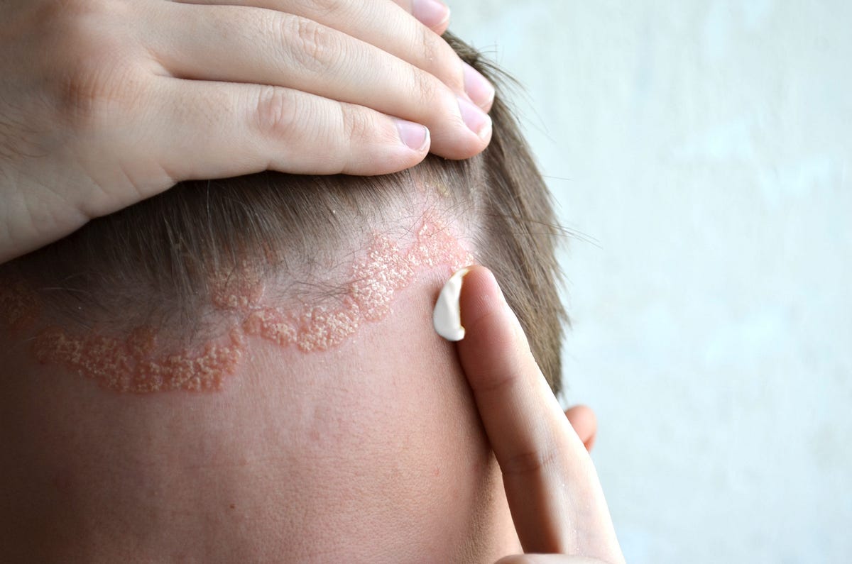 How to treat scalp psoriasis naturally at home by Raneem Mustafa Medium