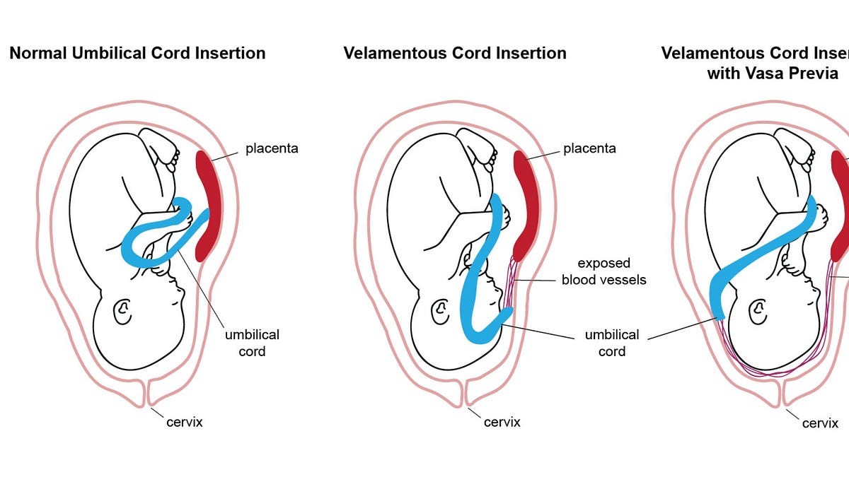 What Is Marginal Cord Insertion? healtywealthy Medium