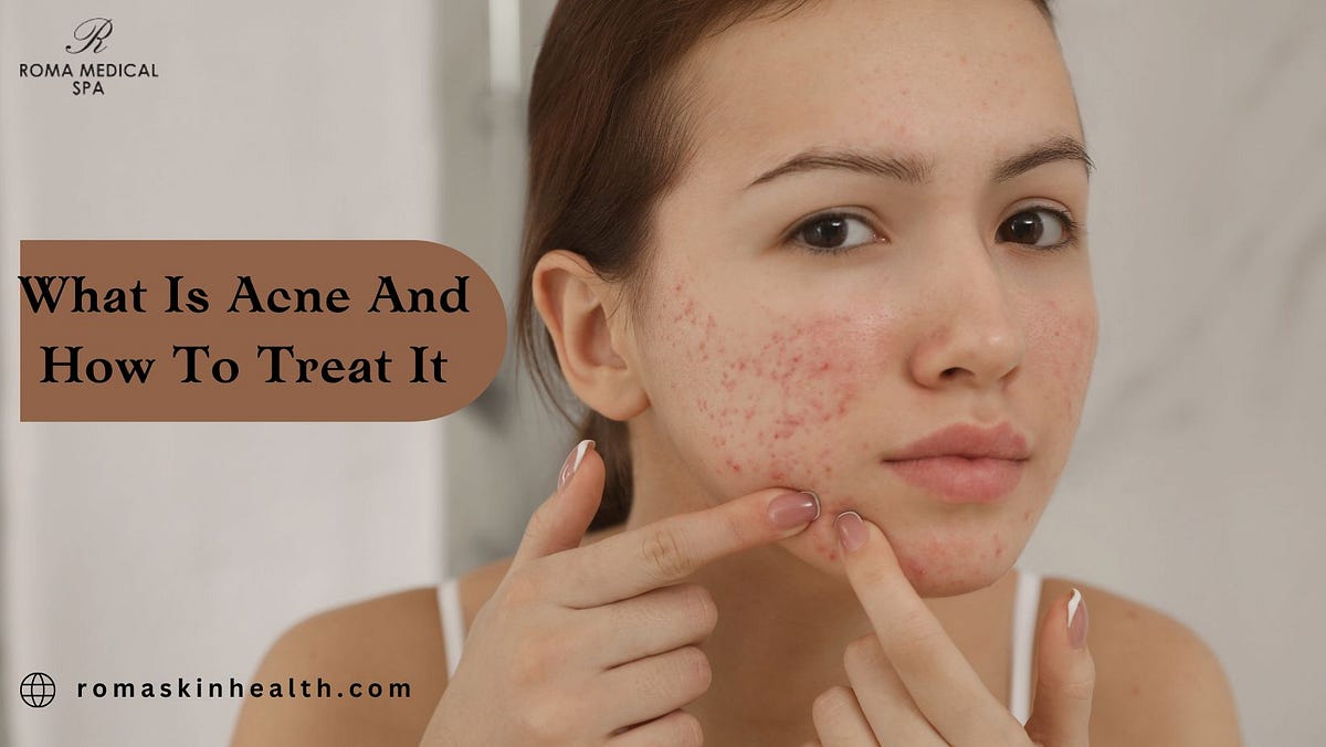 What Is Acne And How To Treat It. Acne is a skin problem that causes