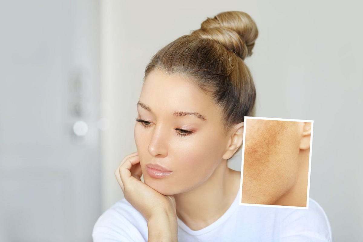 How to get rid of spots and black dots on the face by Luisa Vazquez