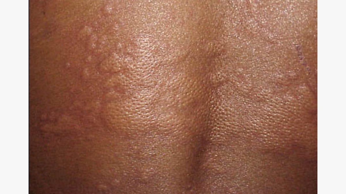 Everything You Need to Know About Preventing and Treating Allergic Reactions Related To Waxing