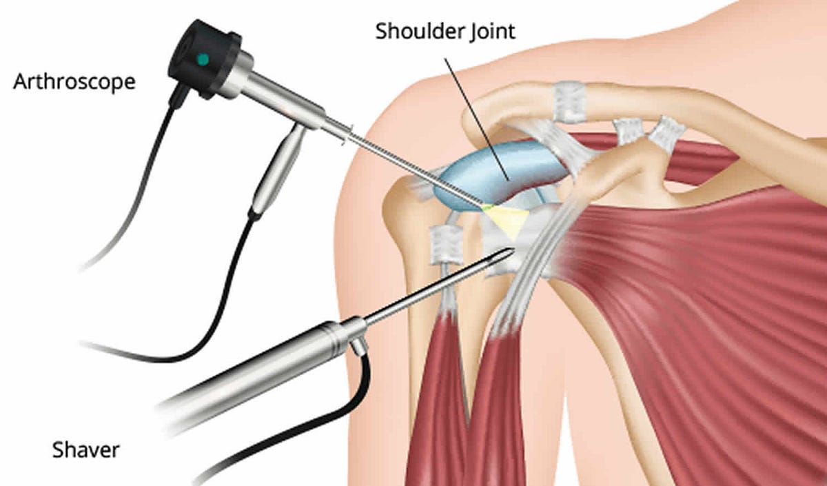 Shoulder Wellness on a Budget Understanding Arthroscopic Surgery Costs