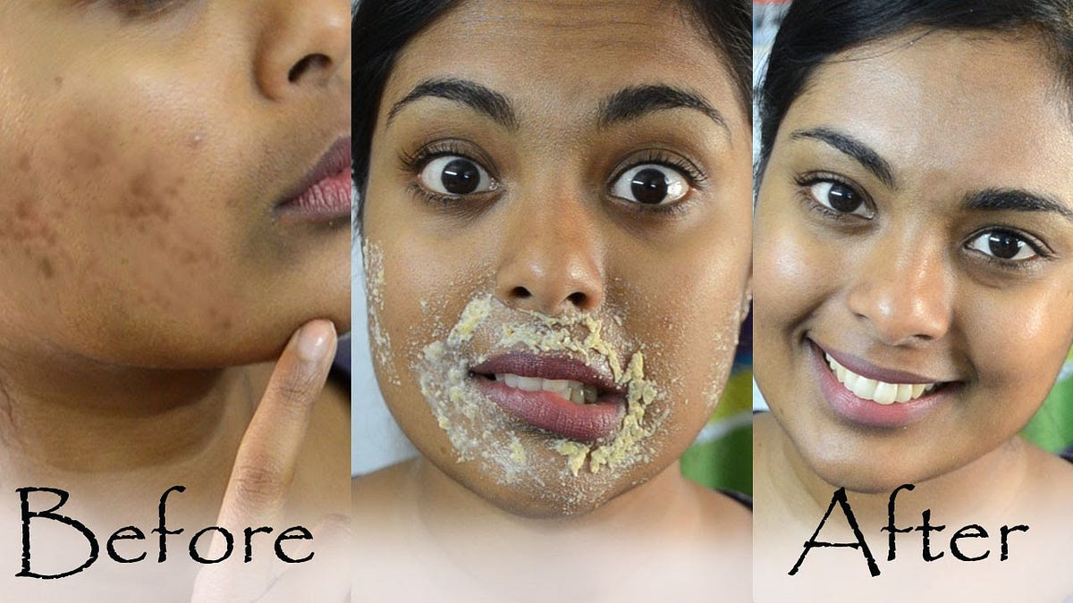 How To Remove Dark Spots On Face Fast Naturally Danialkareemghori