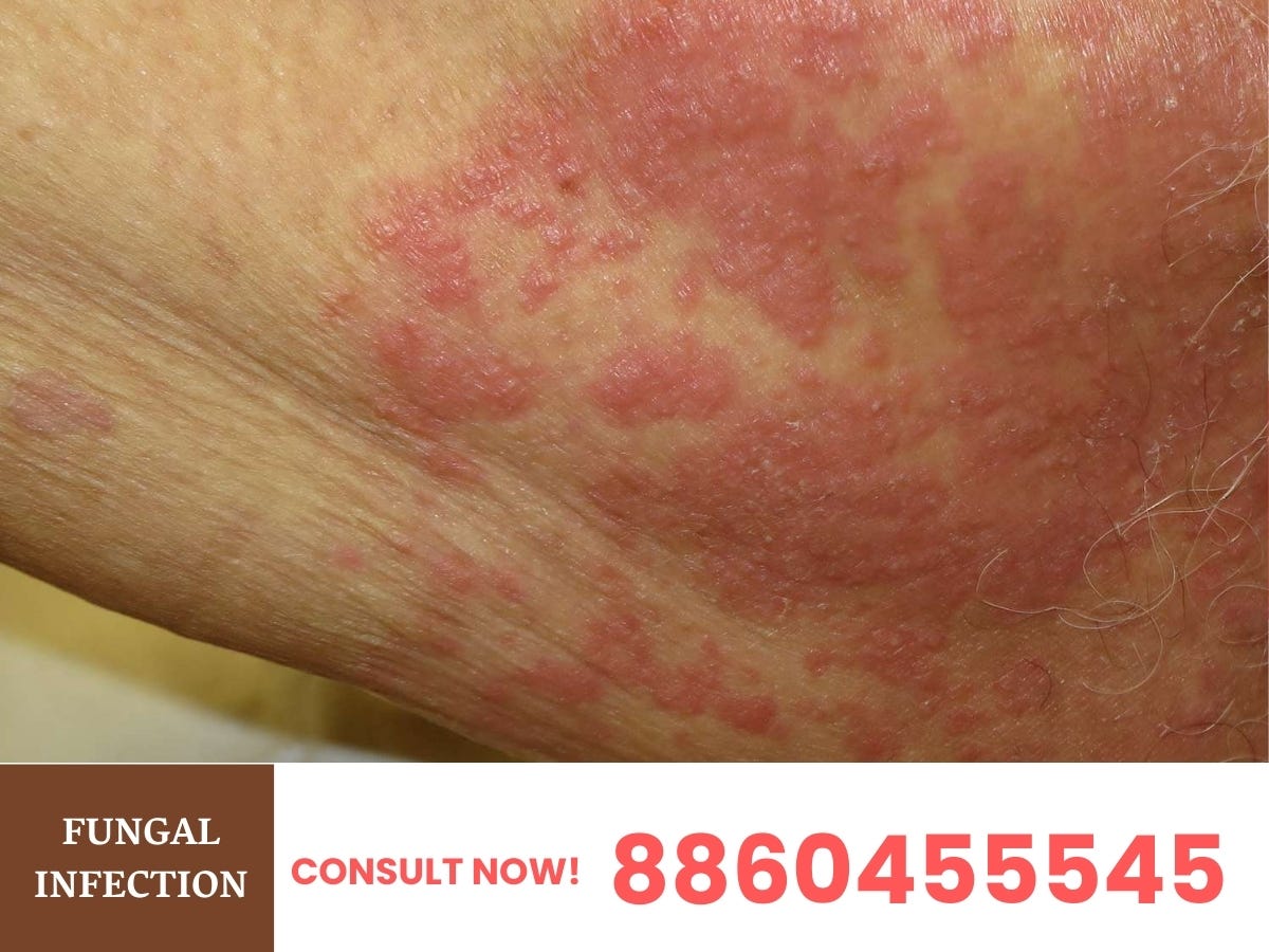 Fungal Infection — Symptom, Causes & Treatment in Deoria by Dr