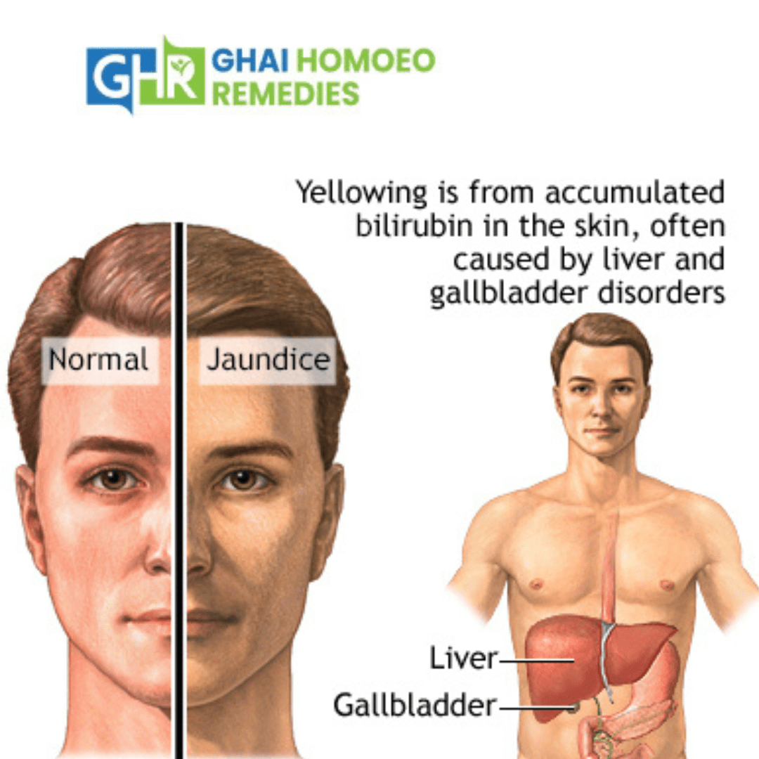Homeopathic Remedy for Jaundice — Importance of Homeopathic Treatment