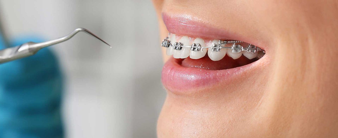 Braces for Bite Issues How They Correct Overbites and Underbites Medium