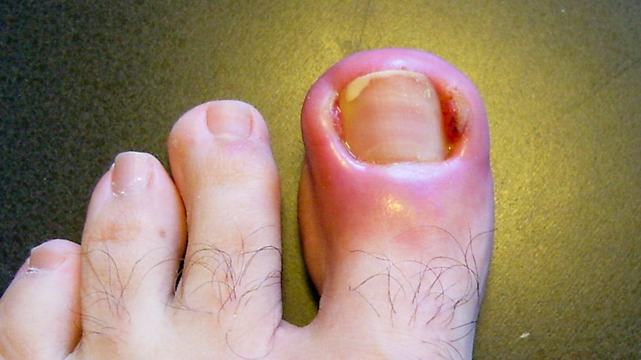 Understand Toe Pain Causes and Symptoms in Detail by Ellenkuhn Medium